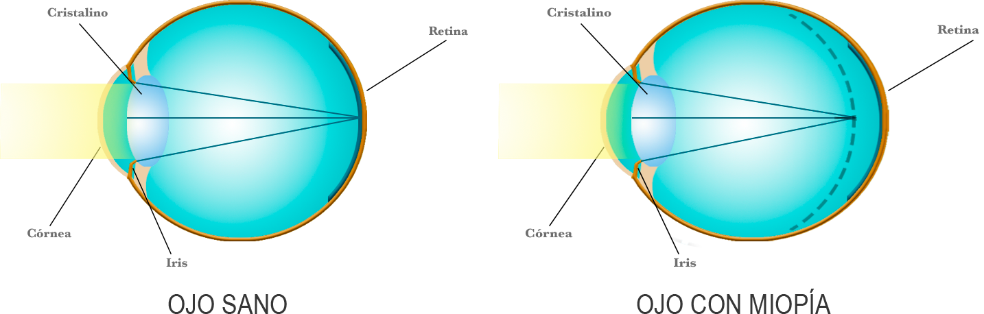 http://www.oculaser.es/img/miopia-detallada.png