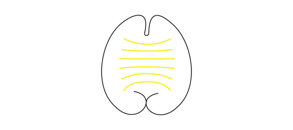 La imagen muestra una representación esquemática del cuerpo calloso, una estructura del cerebro que conecta los hemisferios izquierdo y derecho, facilitando la comunicación entre ellos. Las líneas amarillas representan las fibras que atraviesan el cuerpo calloso, transmitiendo información entre ambas mitades del cerebro para coordinar funciones cognitivas y motoras.